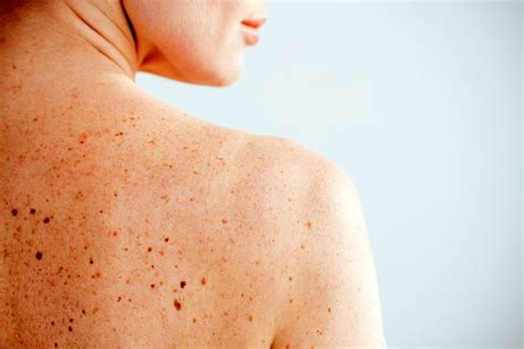 Les chocs électriques contre le cancer de la peau